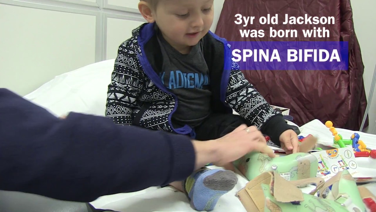 Spina Bifida