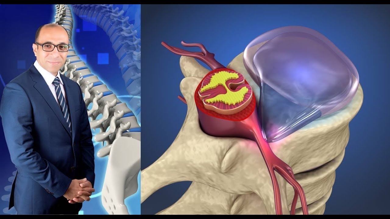 الفرق بين الغضروف القطني و الصدري و العنقي في الأعراض