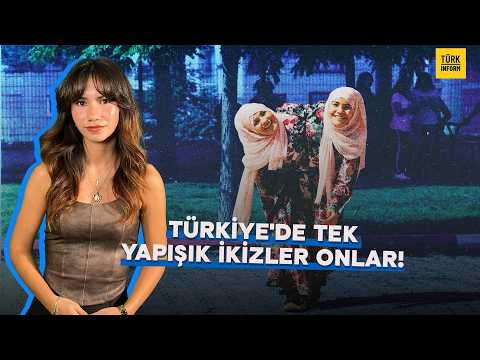 The Astonishing Life of Conjoined Twins Sema and Ayşe: Two Different Brains, One Body