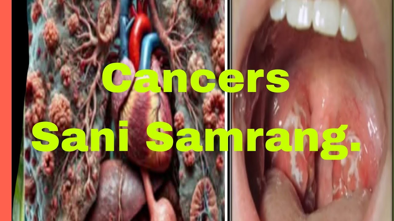 Been ningo Cancer  Sani Samrang.Gitoko.Bikao. Soko. Kasopo Bibiko.