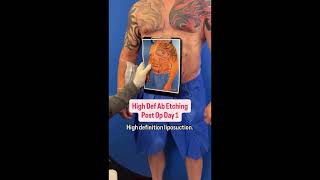 Post Op Day 1 of High-Definition Ab Etching in NYC with Dr. Pakeman!
