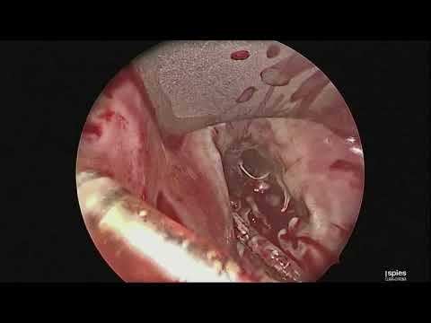 Videó: Egyidejű Ingerlés A Koszorúér Sinus Két ágából Egy Protetikus Tricuspid Szeleppel és Teljes Szívblokkos Betegnél