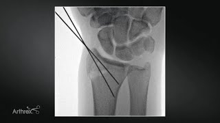 Distal Radius Fracture Management Using the NanoNeedle Scope System