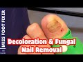 Decoloration &amp; Fungal Nail Removal Full Treatment *** Fungal Nail*** By Miss Foot Fixer