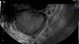 Video 1: Ovarian endometrioma with lateral mobility Video 3 Normal Ovarian Mobility