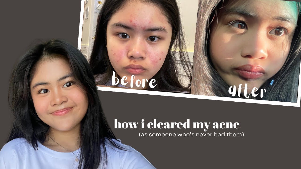 HOW I CLEARED MY ACNE | acne journey, tips&tricks, current skin ...