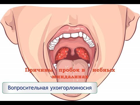 Вопрос: Как предотвратить образование пробок в миндалинах?