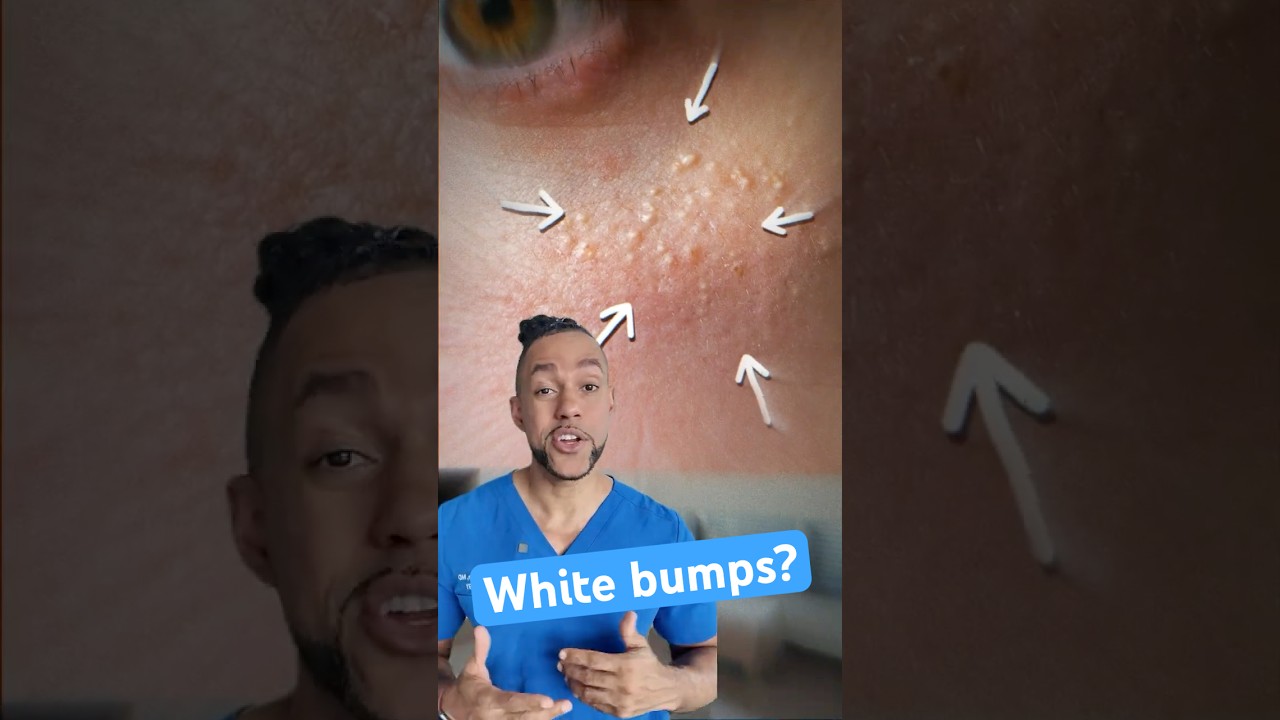 Don't Pick These White Bumps!
