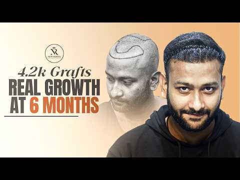High Density Hair Transplant: 6 Months Result Revealed 😎 | Hair Transplant in Siliguri | New Roots