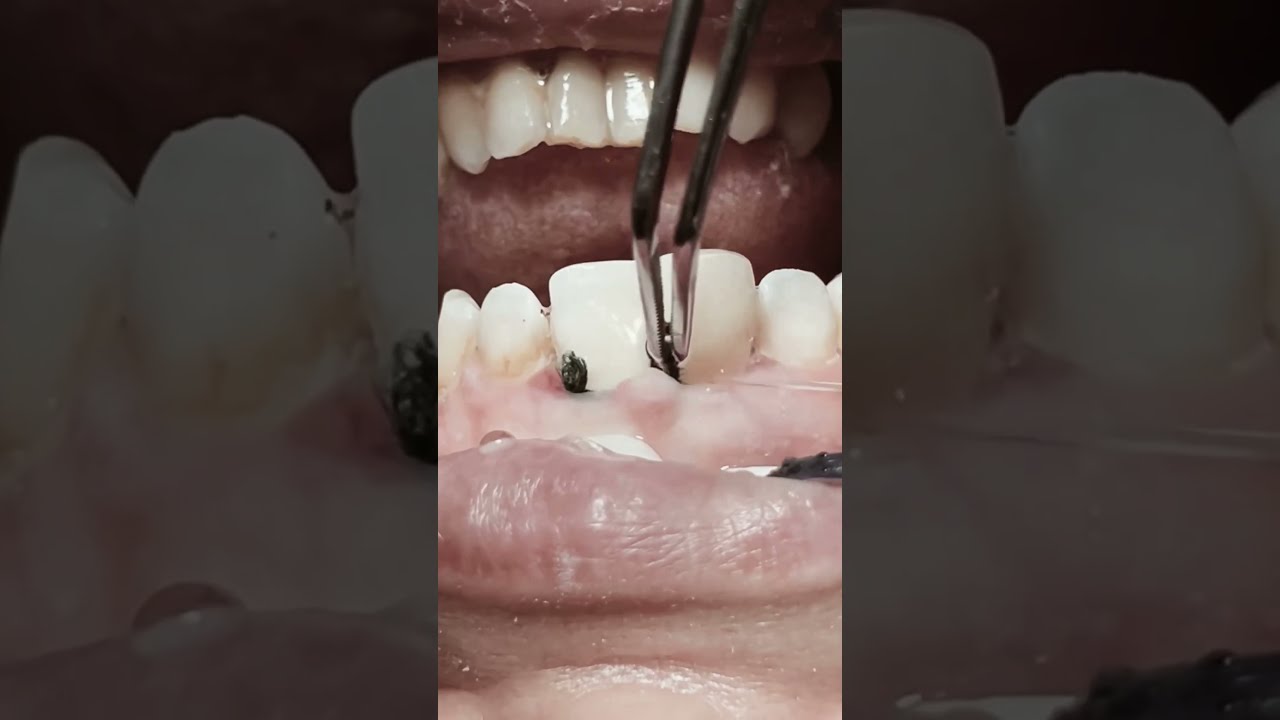 Removing Retraction Cord After RCT And Composite Restoration For Anterior Teeth Satisfying