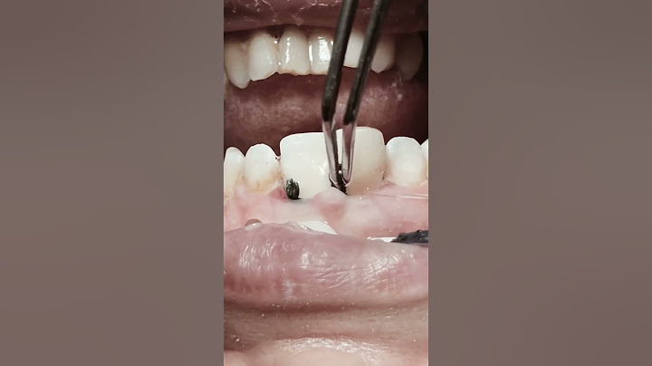 Removing retraction cord after RCT and composite restoration for anterior teeth #satisfying