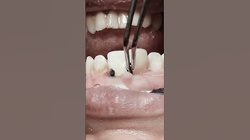 Thumbnail of Removing retraction cord after RCT and composite restoration for anterior teeth #satisfying