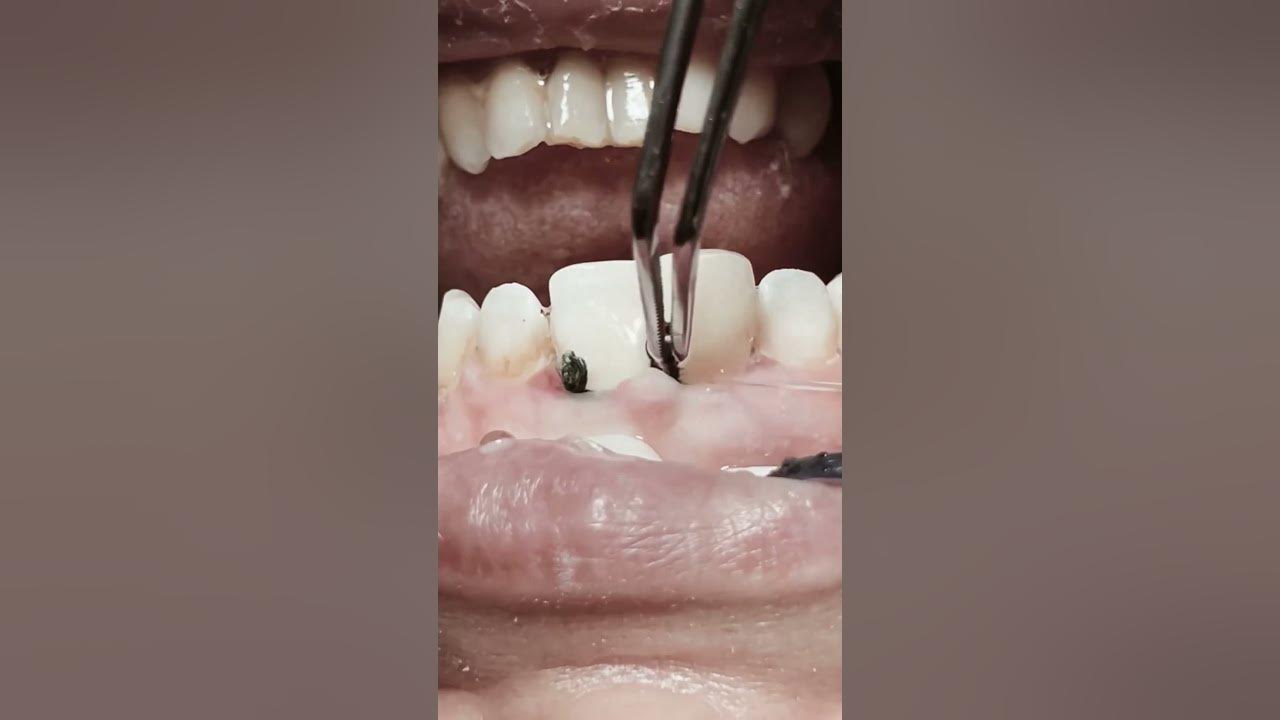 Removing retraction cord after RCT and composite restoration for anterior teeth #satisfying