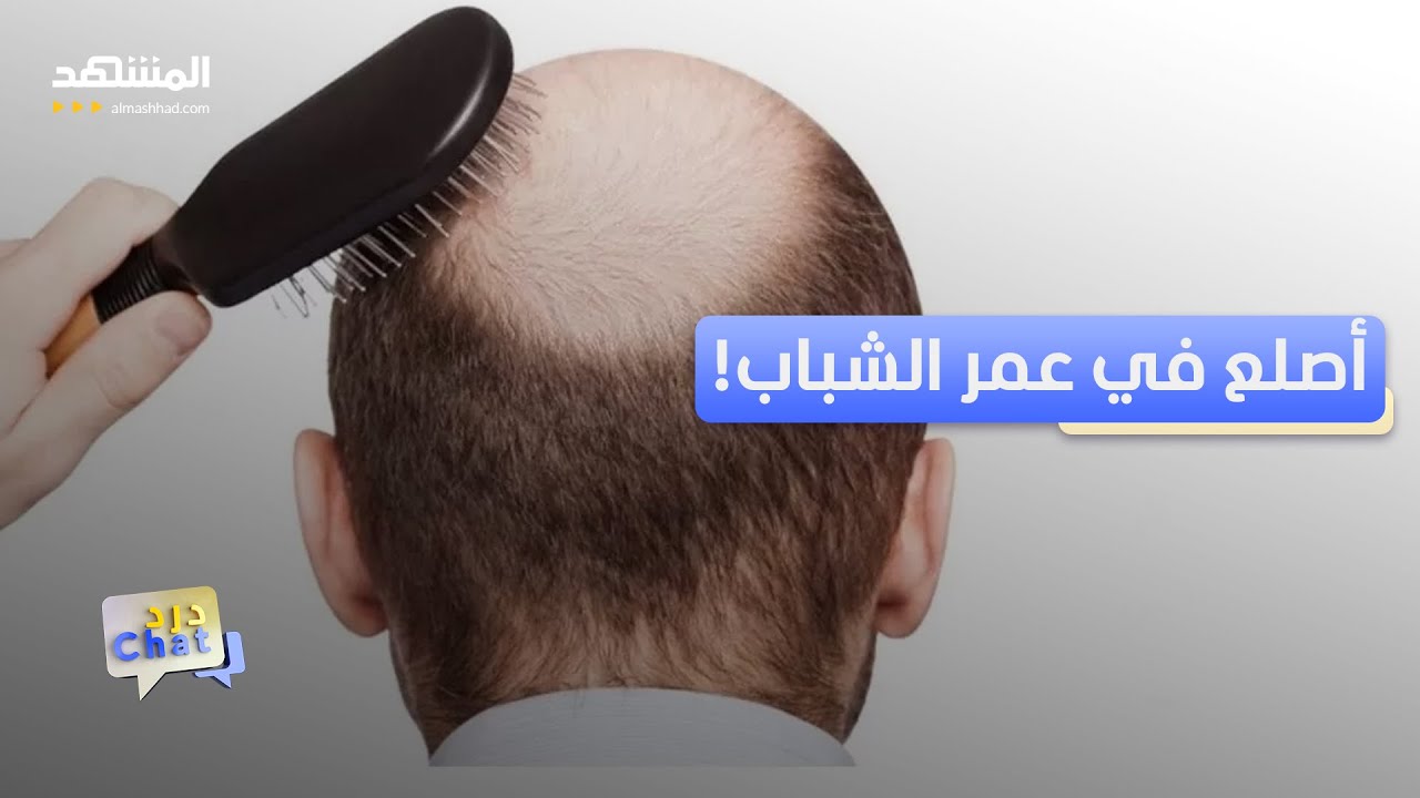 منها السهر والسوشيال ميديا.. أسباب تجعلك أصلع في العشرينات – دردشات ...