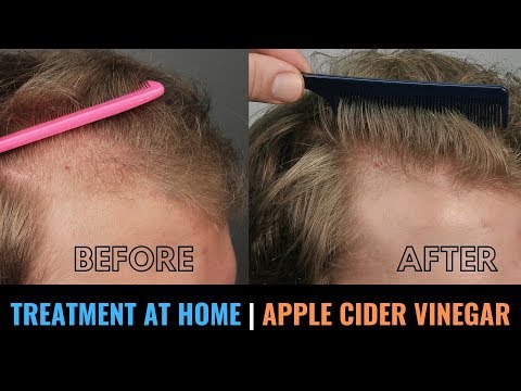 hair-loss-treatment-at-home-with-apple-cider-vinegar---dandruff,-itchy-scalp,-dry-hair-cure