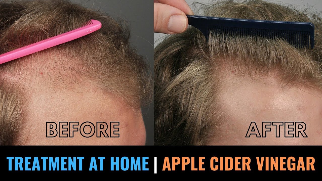 Hair Loss Treatment At Home With Apple Cider Vinegar Dandruff Itchy