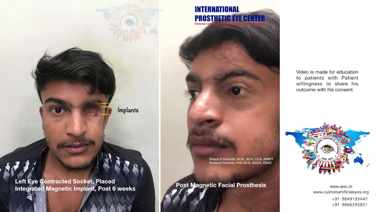 Facial Prosthesis Magnetic Implant Supported Implants Facial Supportive