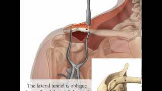 LARS Ligament ACJ.mov