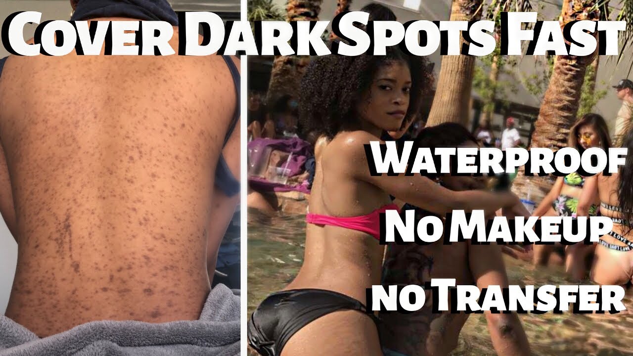 How To Get Rid Of Dark Spots FAST Cover Dark Spots WITHOUT Makeup how-to-get-rid-of-dark-spots-fast-cover-dark-spots-without-makeup