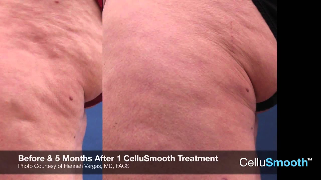 CelluSmooth Sciton A Breakthrough in Body Contouring Laser