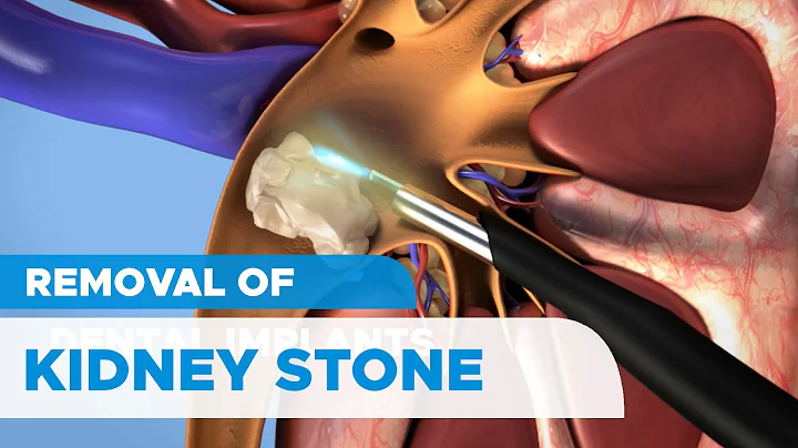 Removal of Kidney Stones: Percutaneous Nephrolithotomy (PCNL) for Kidney Stones - DayDayNews