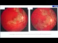 AIOC2024 IC144 Topic Dr Vishali Gupta Pigmentary Fundus With Uveitis How To Proceed AIOC2024 IC144 Topic Dr Vishali Gupta Pigmentary Fundus With Uveitis How To Proceed