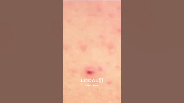 Measles cases hit 30-year high in U.S.