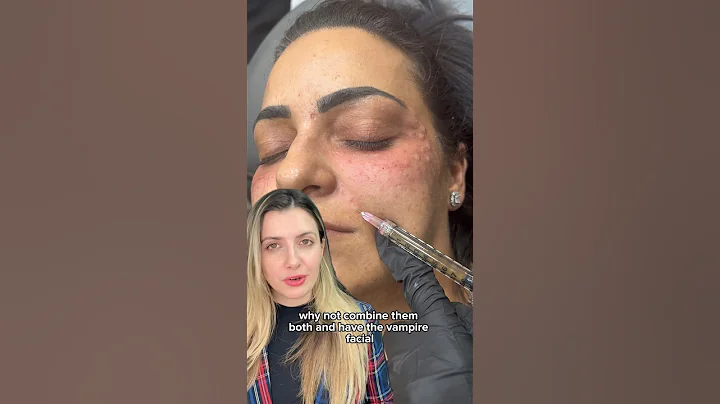 PRP MICRONEEDLING VS. PRP INJECTION | Dr. Medispa