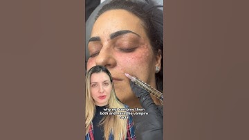 PRP MICRONEEDLING VS. PRP INJECTION | Dr. Medispa