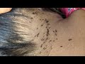 Lice removal from hair  get out all of lice from head