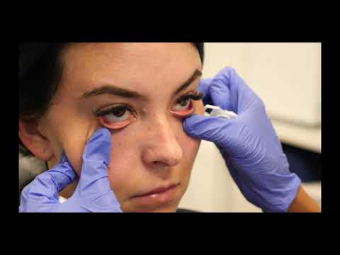 Under Eye Rejuvenation, Jawline & Chin Augmentation - YouTube
