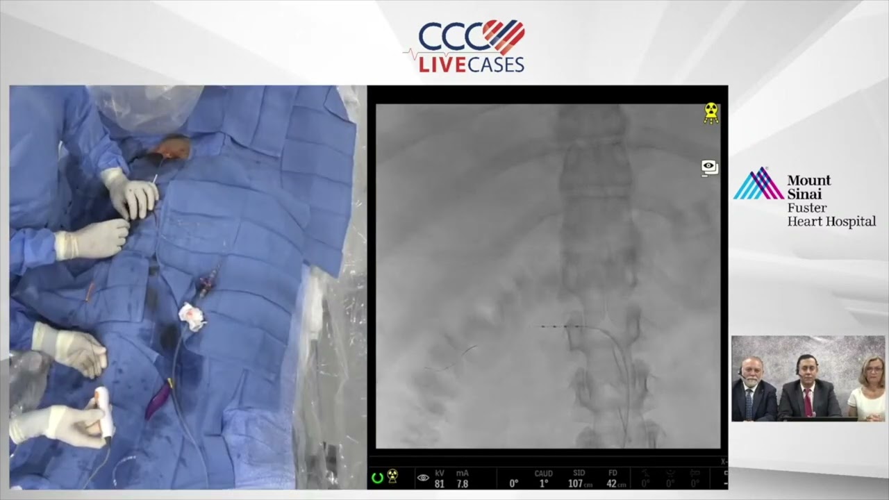 Live Case: Medtronic Renal Denervation (Symplicity Spyral RDN)