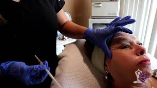 Qué Son Los Hilos Tensores? - Ecologica Medical Spa