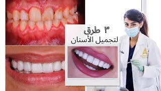 ٣ طرق لتجميل الأسنان