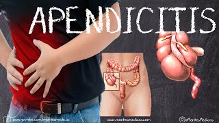 Apendicitis Aguda ¡Fácil Explicación! Anatomía, Fisiopatología, Clínica, Signos, DX | Mentes Médicas
