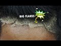 Satisfying Dandruff Removal Big Flakes #519