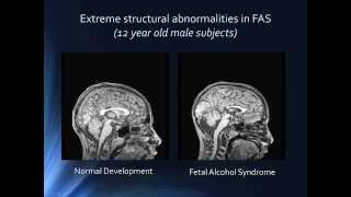 NOFAS Webinar: Treating FASD with Nutritional Interventions