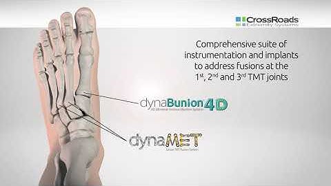 The Power of DynaBunion® Now for LESSER TMT Fusions - Introducing dynaMet™ Coming June 22nd