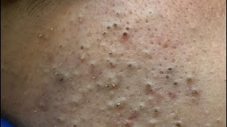 Eunha Natural Remedies For Blackheads Removal (Korean Skincare Routine)