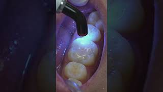 From a deep cavity to a perfectly sealed, healthy smile.#restoration #teeth