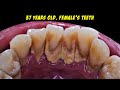 Teeth Cleaning | Tartar | Scaling | Dentist | Dokter Gigi Tri Putra