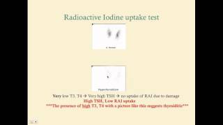 Thyroiditis - CRASH! Medical Review Series