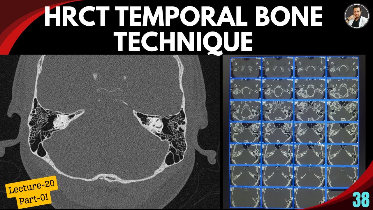 HRCT of Temporal Bone Technique - Lecture:20 (Part-01) |Tutorial-38| Inner ear anatomy | Mastoid CT|