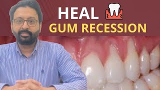 Gum Massage to  Heal Receding Gums and  Grow Gums Back