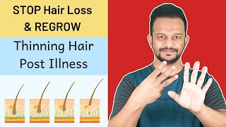 8 Easy Ways to QUICKLY REGROW AND THICKEN HAIR after COVID, Fever or any Illness