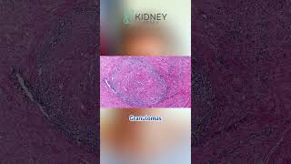 How Granulomas Are Formed? | What Causes Granulomas? | #Sarcoidosis #Granulomas #WhiteBloodCells