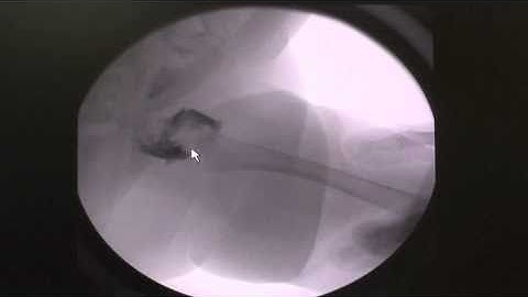 Arthrogram in child with an unsuccessful hip joint reduction