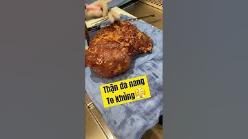THẬN ĐA NANG TO KHỦNG | BÁC SĨ TÙNG SỎI THẬN