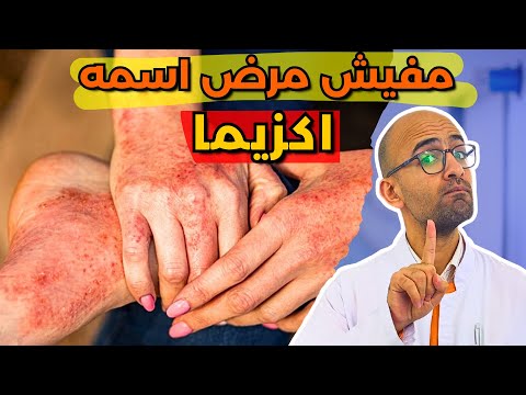يعني ايه اكزيما اسباب الاكزيما و انواعها و علاجها