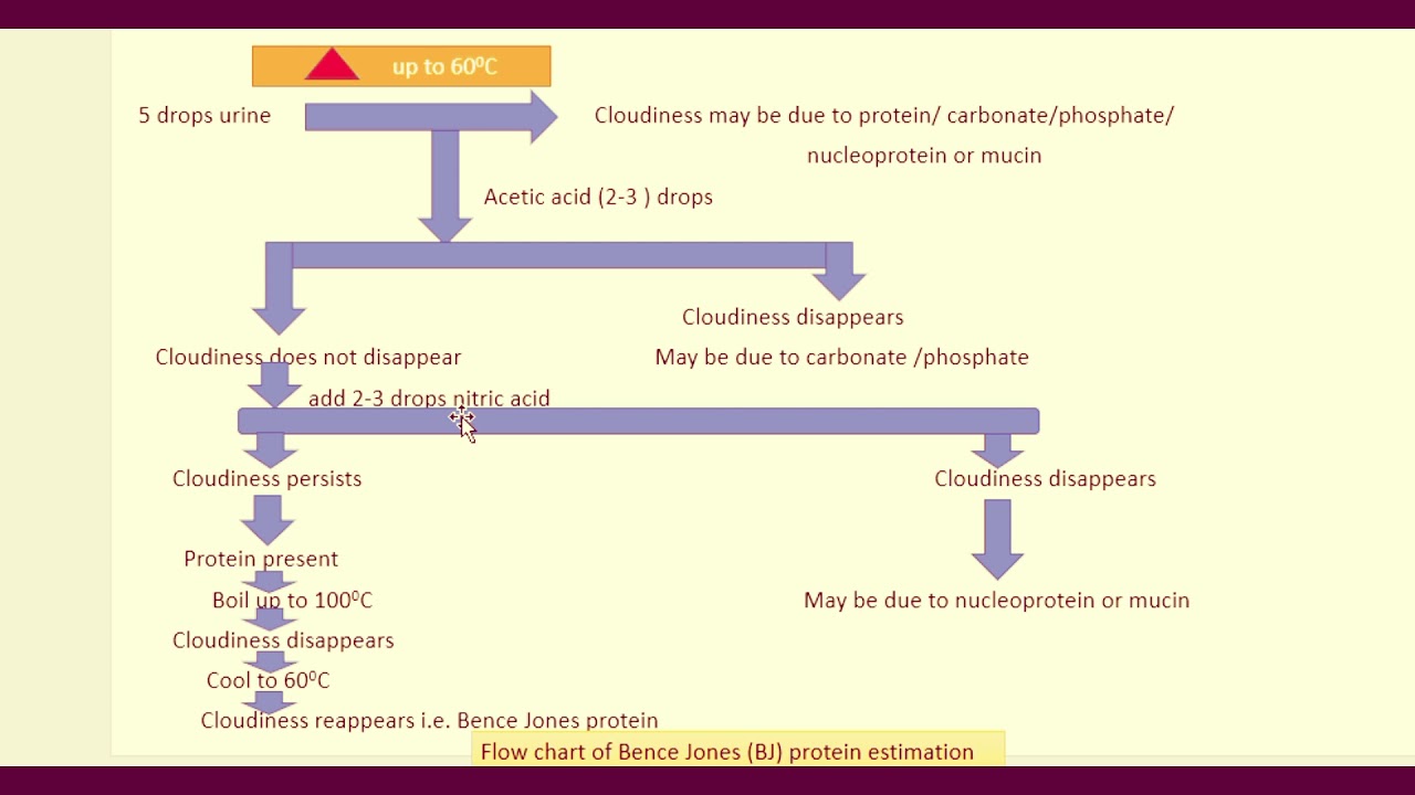 Multiple Myeloma Bence Jones protein urine test and its clinical